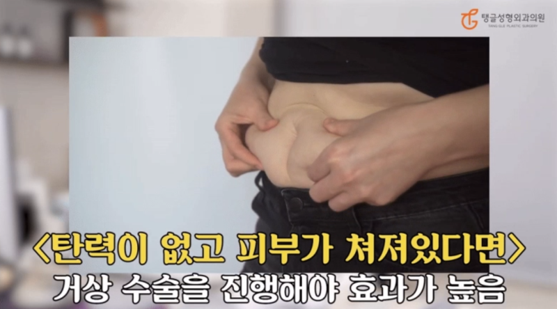 Abdominal Liposuction: Who Might Regret It? 사진 2