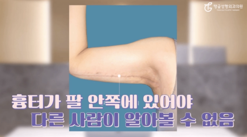 Arm Lift: Is It for Everyone?