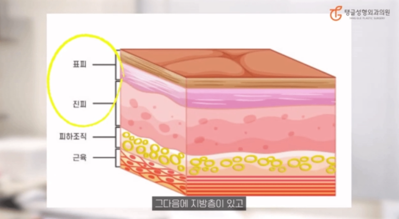 Abdominoplasty: Is It Really Necessary? 사진 2