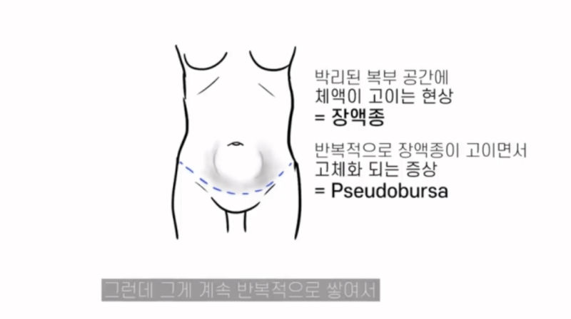 다이어트처진살, 지방흡입으로 될까요?