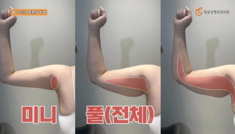 Arm Lift Surgery: Are You Concerned About Sagging Skin?