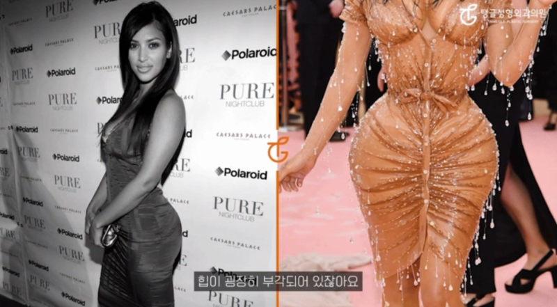 Butt Lift: How to Get the Pelvis You Desire 사진 3