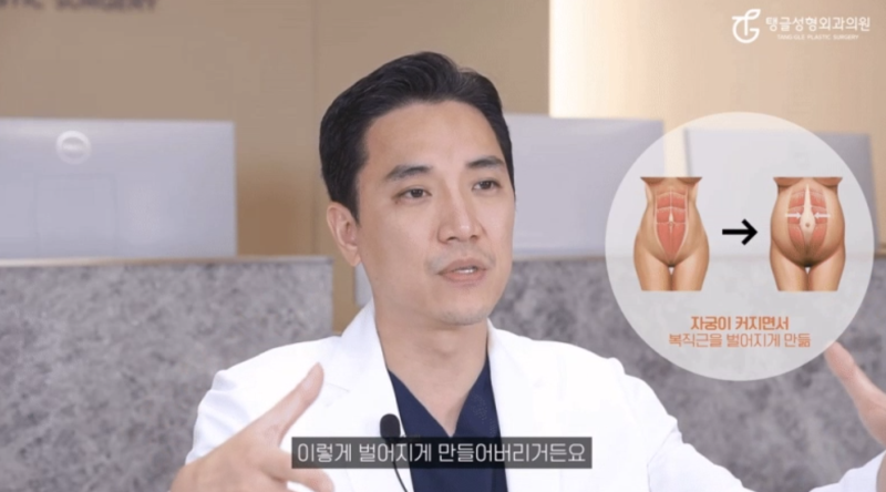 Abdominal Liposuction: Who Won't See Results 사진 2