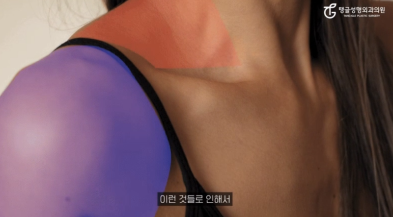 Shoulder Filler: Achieving a Straight Shoulder Line 사진 3