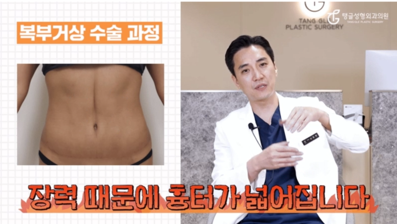 Tummy Tuck Scars: Are You Worried About Them?