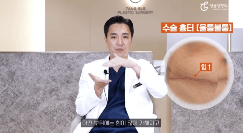 Tummy Tuck Scars: Are You Worried About Them? 사진 4