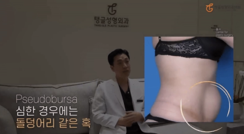 Mini Tummy Tuck: Small Incision and Fast Recovery 사진 3