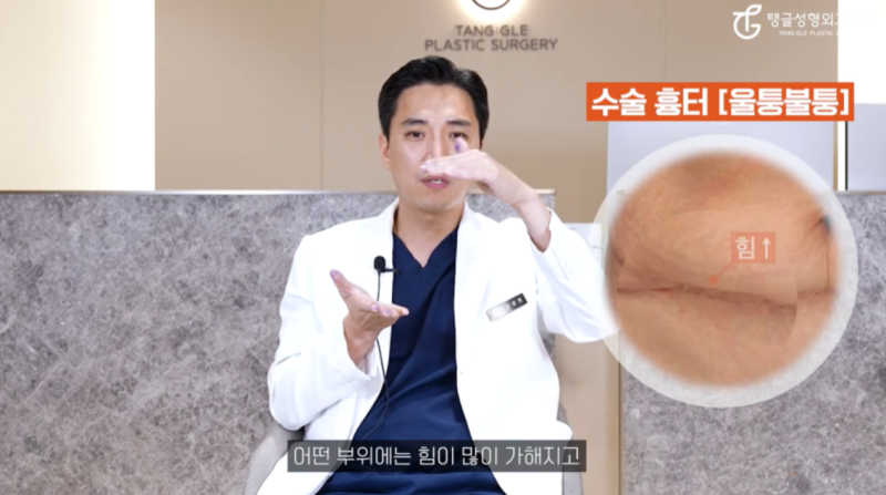 Mini Tummy Tuck: If Summer Makes You Hesitate
