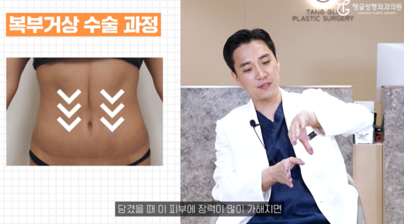 Mini Tummy Tuck: If Summer Makes You Hesitate