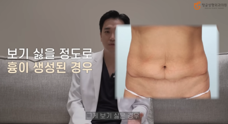 Abdominal Liposuction Side Effects: Is Losing Weight a Lifelong Task? 사진 2