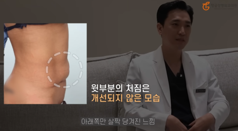 Abdominal Liposuction Side Effects: Is Losing Weight a Lifelong Task?