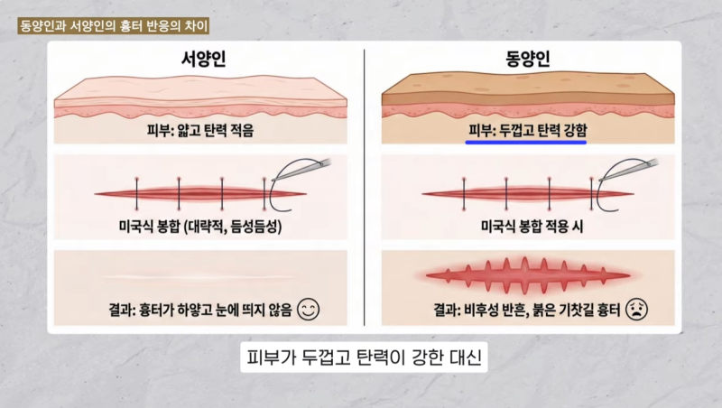 The Decisive Difference: Why Overseas Koreans Insist on Korean Plastic Surgery! 사진 4