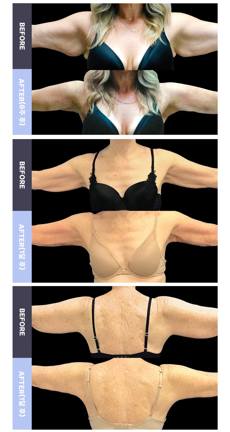 Renewvion: Liposuction and Tightening Simultaneously, Without Scars 사진 11