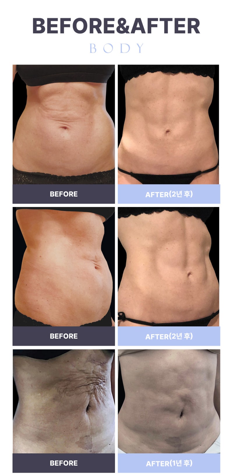 Renewvion: Liposuction and Tightening Simultaneously, Without Scars 사진 10