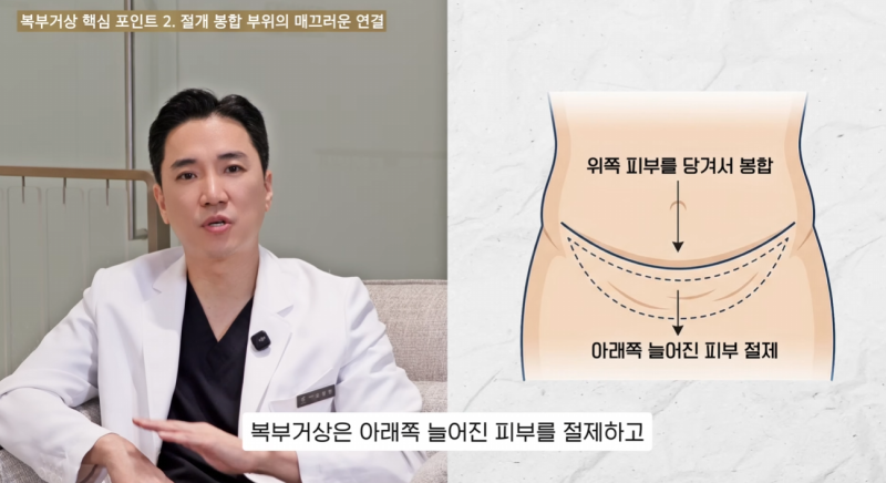 3 Key Points for Tummy Tuck: What You Must Know Before Surgery 사진 3