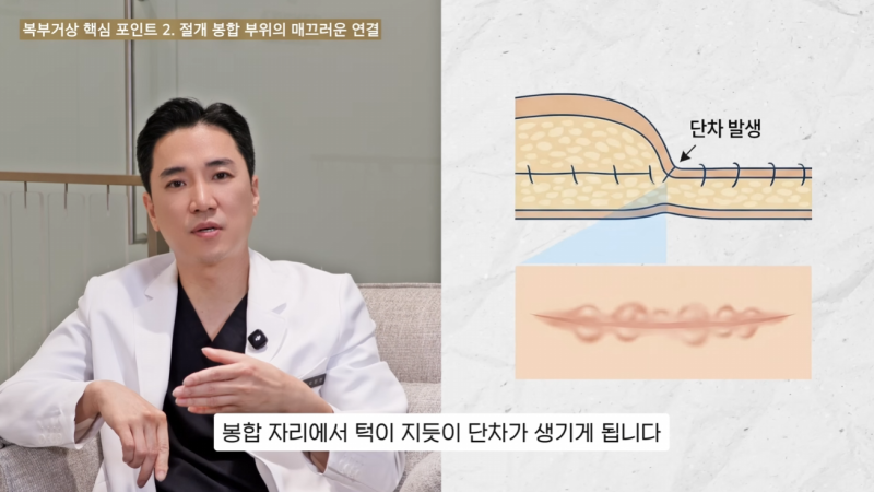 3 Key Points for Tummy Tuck: What You Must Know Before Surgery