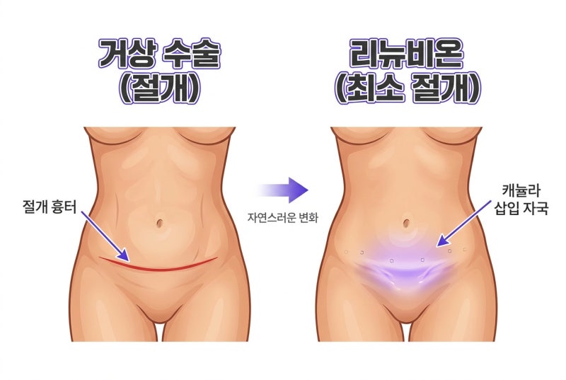 Curious about Abdominal Tightening Renuvion? From Effects to Recovery! 사진 4