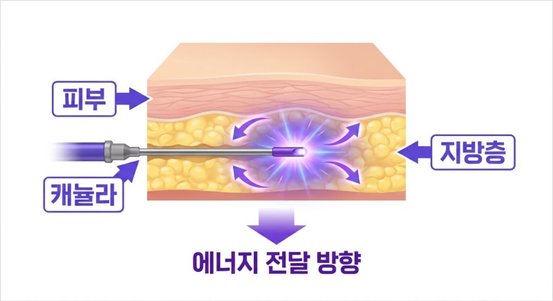 Curious about Abdominal Tightening Renuvion? From Effects to Recovery!