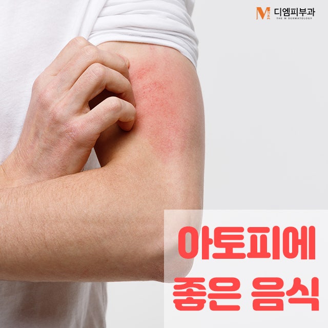 아토피에좋은음식으로 가려움과 이별하자