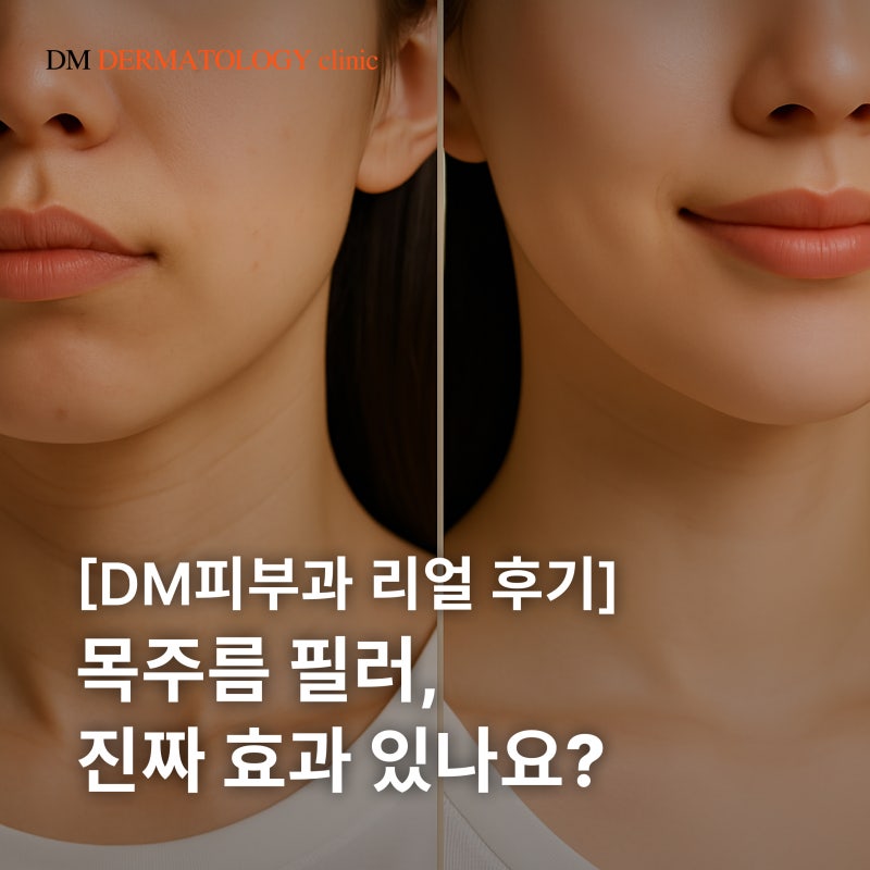 목주름 필러 - 깊은 주름 개선, 어떤 시술이 효과적일까?