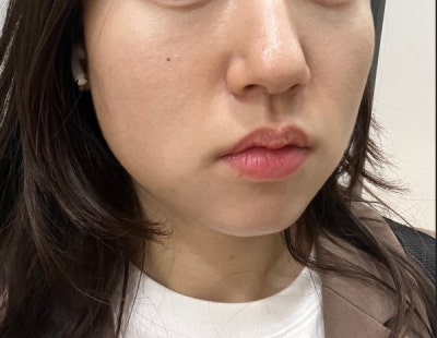 [나인의원홍대] 홍대피부과 리쥬란힐러, 효과가 없었던 이유. 사진 7