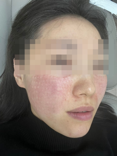 [나인의원홍대] 홍대피부과, 리쥬란힐러 통증없이 맞을 수 있다고? 사진 5
