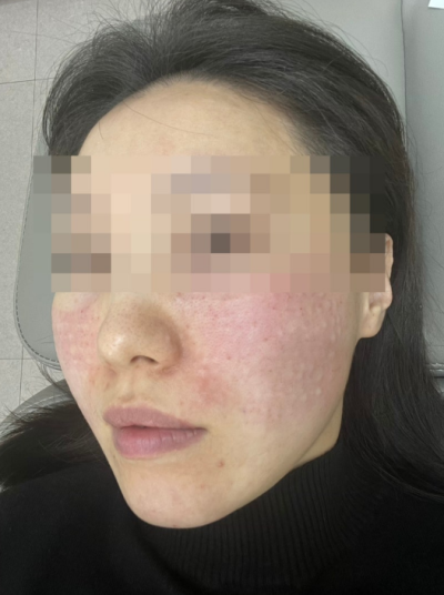 [나인의원홍대] 홍대피부과, 리쥬란힐러 통증없이 맞을 수 있다고? 사진 6