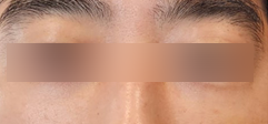 홍대피부과 해골형,땅콩형얼굴이 고민이라면? 수술말고 이것부터 해보세요! 사진 14