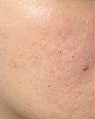 홍대입구피부과 패인 여드름흉터, 울트라펄스 앙코르로 달라질 수 있을까? 사진 11