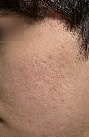 홍대입구피부과 패인 여드름흉터, 울트라펄스 앙코르로 달라질 수 있을까? 사진 9