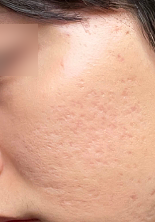 홍대입구피부과 패인 여드름흉터, 울트라펄스 앙코르로 달라질 수 있을까? 사진 8